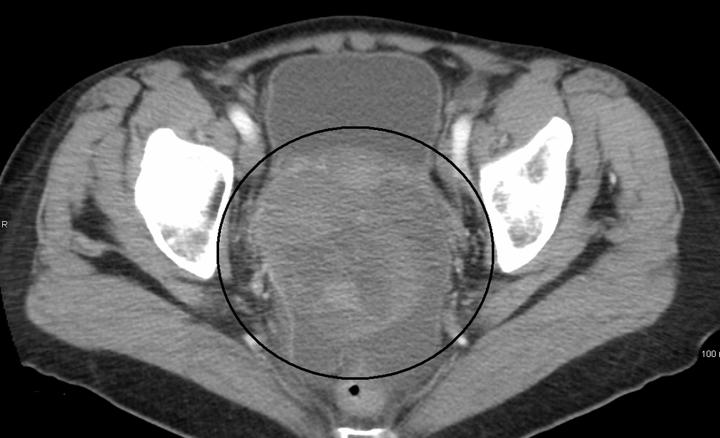 resonancia magnética no invasiva para cáncer de próstata recomendada por Nice resonancia magnética no invasiva para cáncer de próstata recomendada por Nice